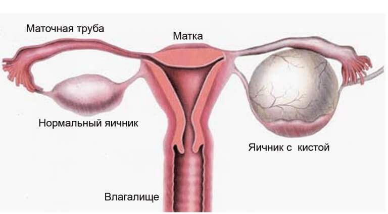 параовариальная киста яичника симптомы